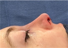 Rhinoplasty After Photo by Mark Markarian, MD, MSPH, FACS; Wellesley, MA - Case 48589