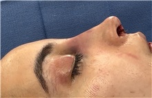 Rhinoplasty After Photo by Mark Markarian, MD, MSPH, FACS; Wellesley, MA - Case 48592