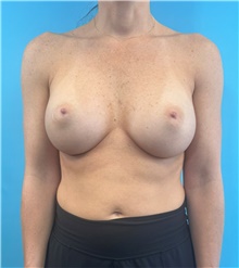 Breast Augmentation After Photo by Mark Markarian, MD, MSPH, FACS; Wellesley, MA - Case 48606