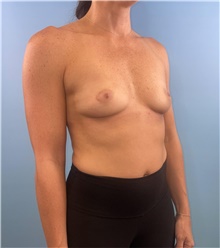 Breast Augmentation Before Photo by Mark Markarian, MD, MSPH, FACS; Wellesley, MA - Case 48606
