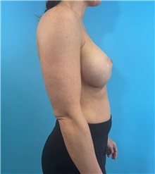 Breast Augmentation After Photo by Mark Markarian, MD, MSPH, FACS; Wellesley, MA - Case 48606