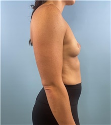 Breast Augmentation Before Photo by Mark Markarian, MD, MSPH, FACS; Wellesley, MA - Case 48606