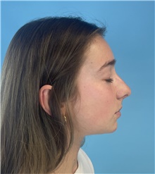 Rhinoplasty Before Photo by Mark Markarian, MD, MSPH, FACS; Wellesley, MA - Case 48667