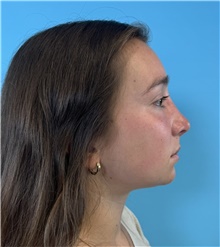 Rhinoplasty After Photo by Mark Markarian, MD, MSPH, FACS; Wellesley, MA - Case 48667