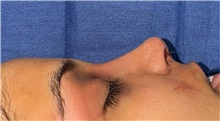 Rhinoplasty After Photo by Mark Markarian, MD, MSPH, FACS; Wellesley, MA - Case 48780