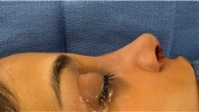 Rhinoplasty After Photo by Mark Markarian, MD, MSPH, FACS; Wellesley, MA - Case 48781