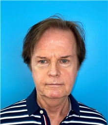 Facelift Before Photo by Mark Markarian, MD, MSPH, FACS; Wellesley, MA - Case 48788