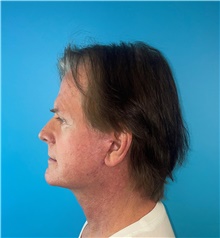 Facelift After Photo by Mark Markarian, MD, MSPH, FACS; Wellesley, MA - Case 48788