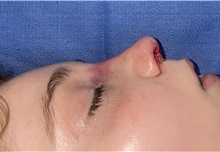 Rhinoplasty After Photo by Mark Markarian, MD, MSPH, FACS; Wellesley, MA - Case 48884