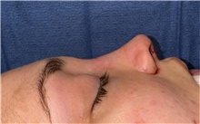 Rhinoplasty After Photo by Mark Markarian, MD, MSPH, FACS; Wellesley, MA - Case 48886