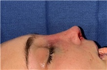 Rhinoplasty After Photo by Mark Markarian, MD, MSPH, FACS; Wellesley, MA - Case 48887