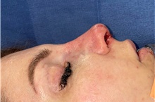 Rhinoplasty After Photo by Mark Markarian, MD, MSPH, FACS; Wellesley, MA - Case 48888