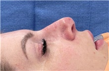 Rhinoplasty Before Photo by Mark Markarian, MD, MSPH, FACS; Wellesley, MA - Case 48888