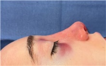 Rhinoplasty After Photo by Mark Markarian, MD, MSPH, FACS; Wellesley, MA - Case 48889
