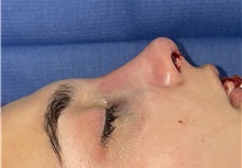 Rhinoplasty After Photo by Mark Markarian, MD, MSPH, FACS; Wellesley, MA - Case 48890