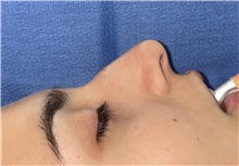 Rhinoplasty Before Photo by Mark Markarian, MD, MSPH, FACS; Wellesley, MA - Case 48890