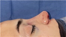 Rhinoplasty After Photo by Mark Markarian, MD, MSPH, FACS; Wellesley, MA - Case 48891