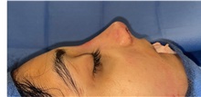 Rhinoplasty After Photo by Mark Markarian, MD, MSPH, FACS; Wellesley, MA - Case 48892