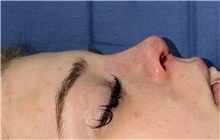 Rhinoplasty After Photo by Mark Markarian, MD, MSPH, FACS; Wellesley, MA - Case 48893