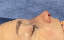 Rhinoplasty After Photo by Mark Markarian, MD, MSPH, FACS; Wellesley, MA - Case 48894