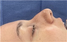 Rhinoplasty Before Photo by Mark Markarian, MD, MSPH, FACS; Wellesley, MA - Case 48894