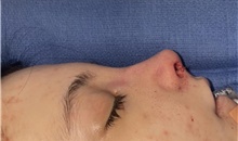 Rhinoplasty After Photo by Mark Markarian, MD, MSPH, FACS; Wellesley, MA - Case 48895