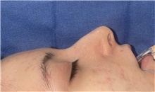 Rhinoplasty Before Photo by Mark Markarian, MD, MSPH, FACS; Wellesley, MA - Case 48895