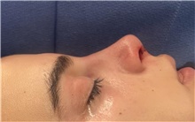 Rhinoplasty After Photo by Mark Markarian, MD, MSPH, FACS; Wellesley, MA - Case 48896