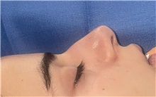 Rhinoplasty Before Photo by Mark Markarian, MD, MSPH, FACS; Wellesley, MA - Case 48896