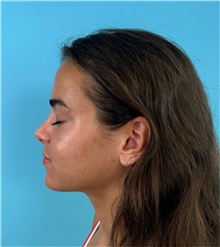 Rhinoplasty After Photo by Mark Markarian, MD, MSPH, FACS; Wellesley, MA - Case 48902
