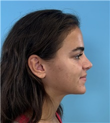 Rhinoplasty After Photo by Mark Markarian, MD, MSPH, FACS; Wellesley, MA - Case 48902