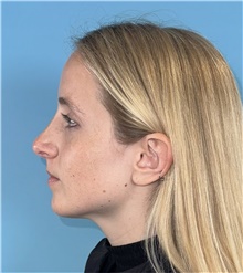 Rhinoplasty After Photo by Mark Markarian, MD, MSPH, FACS; Wellesley, MA - Case 49026