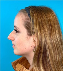 Rhinoplasty Before Photo by Mark Markarian, MD, MSPH, FACS; Wellesley, MA - Case 49026