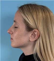 Rhinoplasty After Photo by Mark Markarian, MD, MSPH, FACS; Wellesley, MA - Case 49026