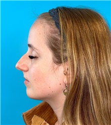 Rhinoplasty Before Photo by Mark Markarian, MD, MSPH, FACS; Wellesley, MA - Case 49026