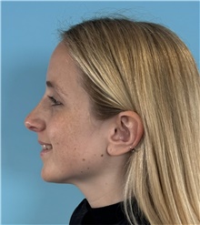 Rhinoplasty After Photo by Mark Markarian, MD, MSPH, FACS; Wellesley, MA - Case 49026