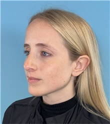 Rhinoplasty After Photo by Mark Markarian, MD, MSPH, FACS; Wellesley, MA - Case 49026