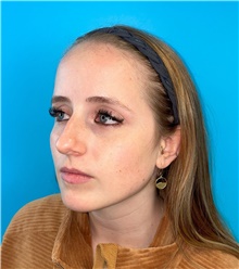 Rhinoplasty Before Photo by Mark Markarian, MD, MSPH, FACS; Wellesley, MA - Case 49026