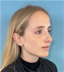 Rhinoplasty After Photo by Mark Markarian, MD, MSPH, FACS; Wellesley, MA - Case 49026