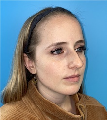 Rhinoplasty Before Photo by Mark Markarian, MD, MSPH, FACS; Wellesley, MA - Case 49026