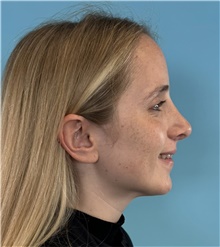 Rhinoplasty After Photo by Mark Markarian, MD, MSPH, FACS; Wellesley, MA - Case 49026