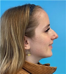 Rhinoplasty Before Photo by Mark Markarian, MD, MSPH, FACS; Wellesley, MA - Case 49026