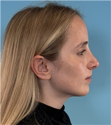 Rhinoplasty After Photo by Mark Markarian, MD, MSPH, FACS; Wellesley, MA - Case 49026