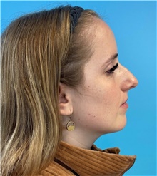 Rhinoplasty Before Photo by Mark Markarian, MD, MSPH, FACS; Wellesley, MA - Case 49026