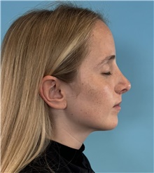 Rhinoplasty After Photo by Mark Markarian, MD, MSPH, FACS; Wellesley, MA - Case 49026