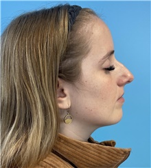 Rhinoplasty Before Photo by Mark Markarian, MD, MSPH, FACS; Wellesley, MA - Case 49026