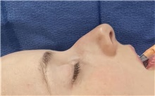 Rhinoplasty Before Photo by Mark Markarian, MD, MSPH, FACS; Wellesley, MA - Case 49026