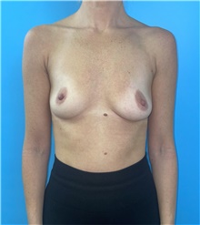 Breast Augmentation Before Photo by Mark Markarian, MD, MSPH, FACS; Wellesley, MA - Case 49145