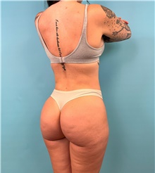 Buttock Lift with Augmentation After Photo by Mark Markarian, MD, MSPH, FACS; Wellesley, MA - Case 49168