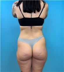 Buttock Lift with Augmentation Before Photo by Mark Markarian, MD, MSPH, FACS; Wellesley, MA - Case 49168